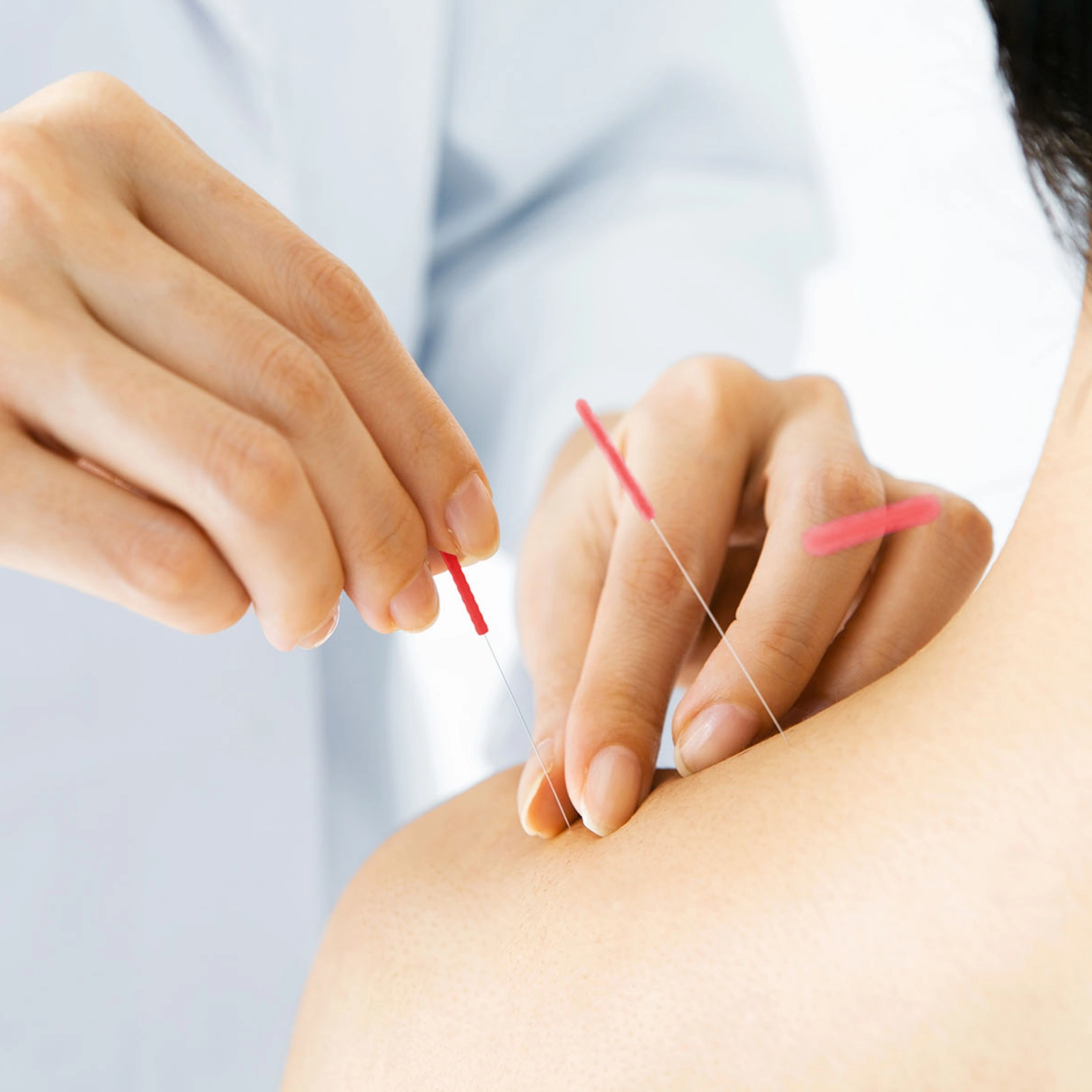 Therapist places needles during acupuncture